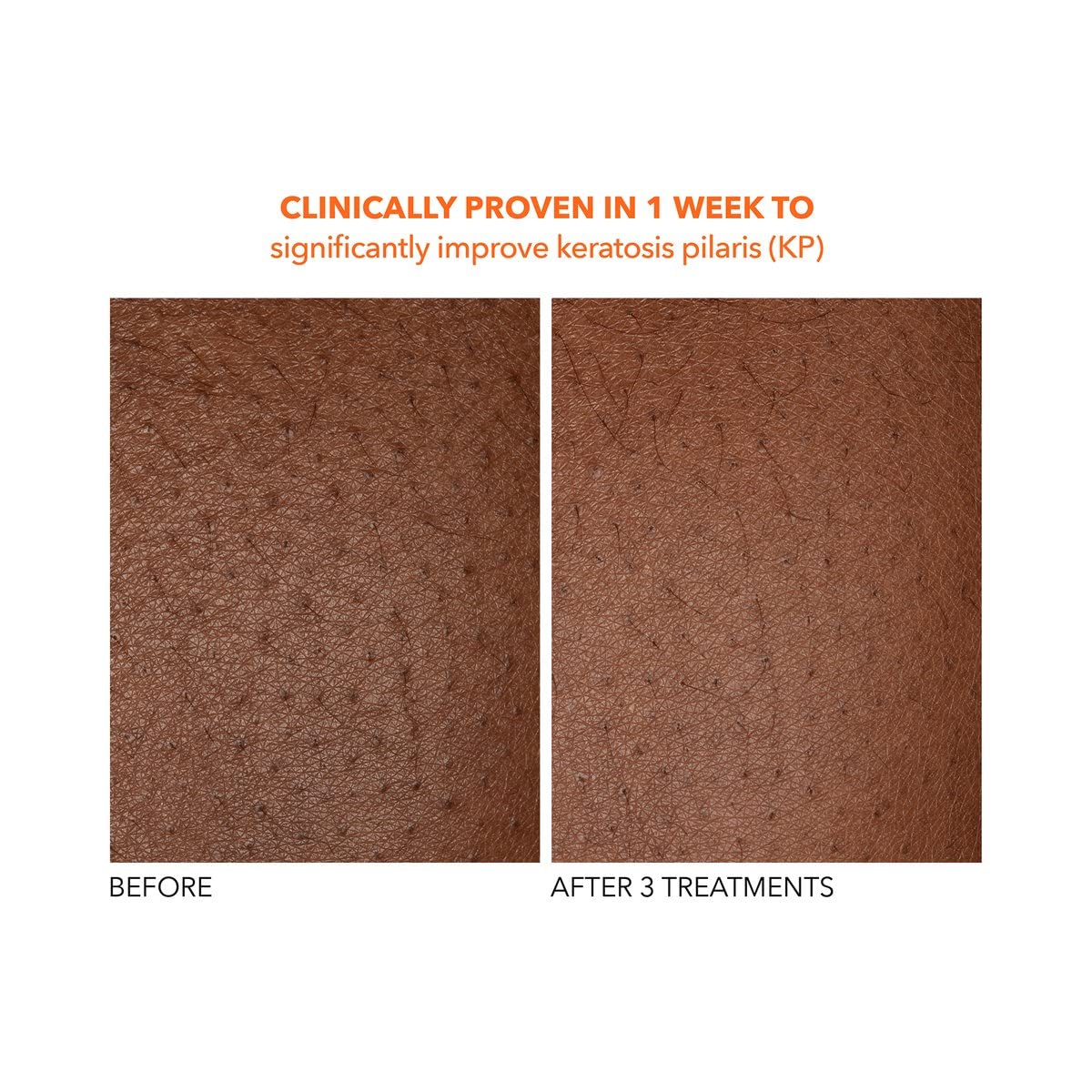 Dr Dennis Gross Alpha Beta Exfoliant Corporel - application sur peau humide