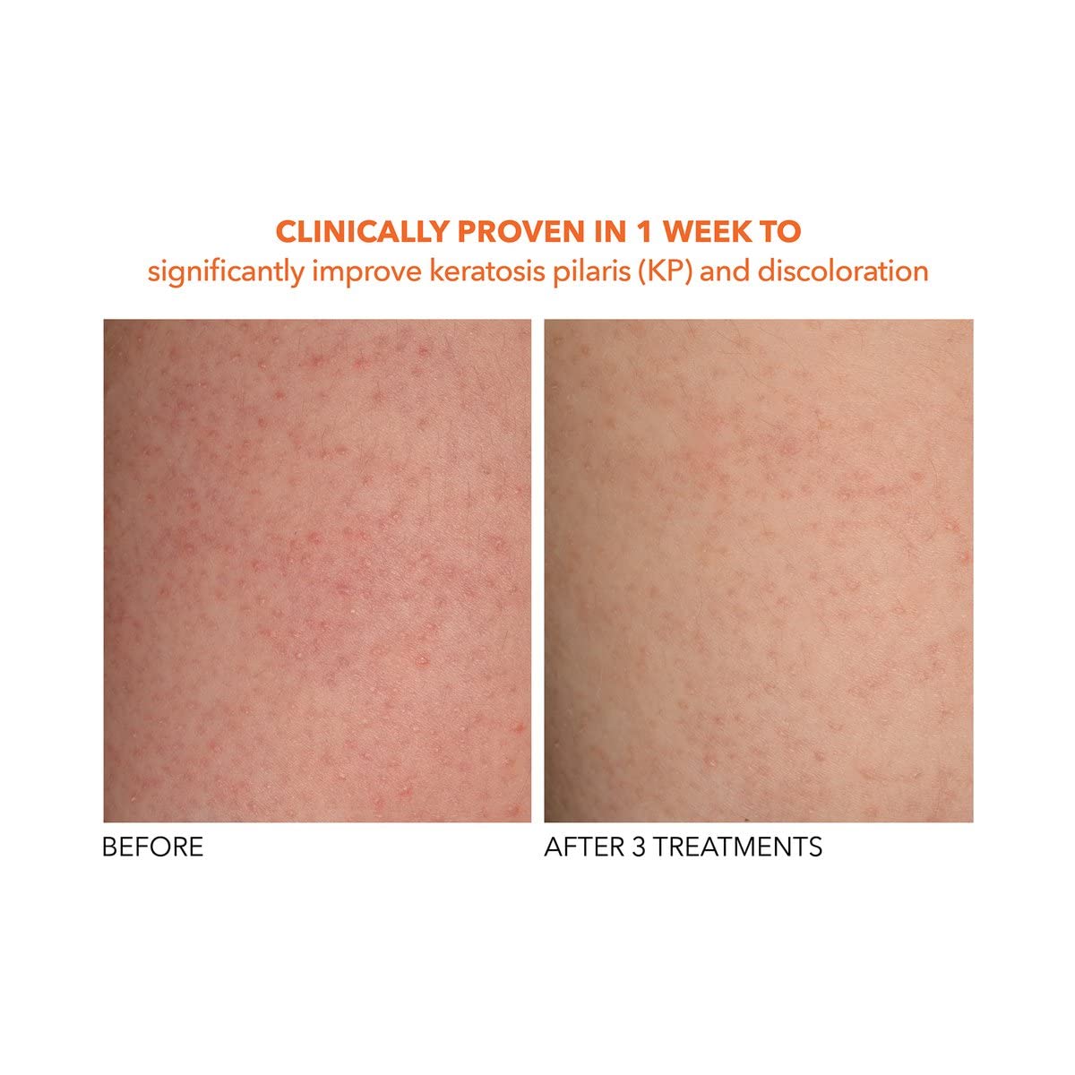 Dr Dennis Gross Alpha Beta Exfoliant Corporel - peau hydratée et protégée