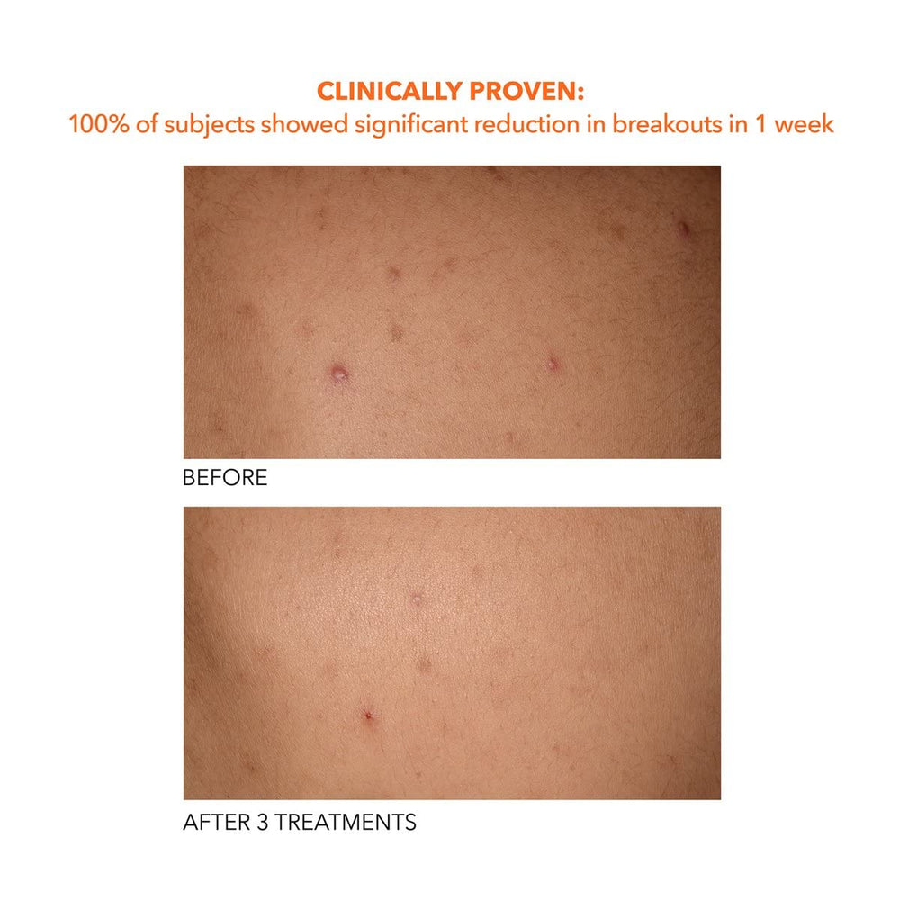Dr Dennis Gross Alpha Beta Exfoliant Corporel - peau plus lisse après utilisation
