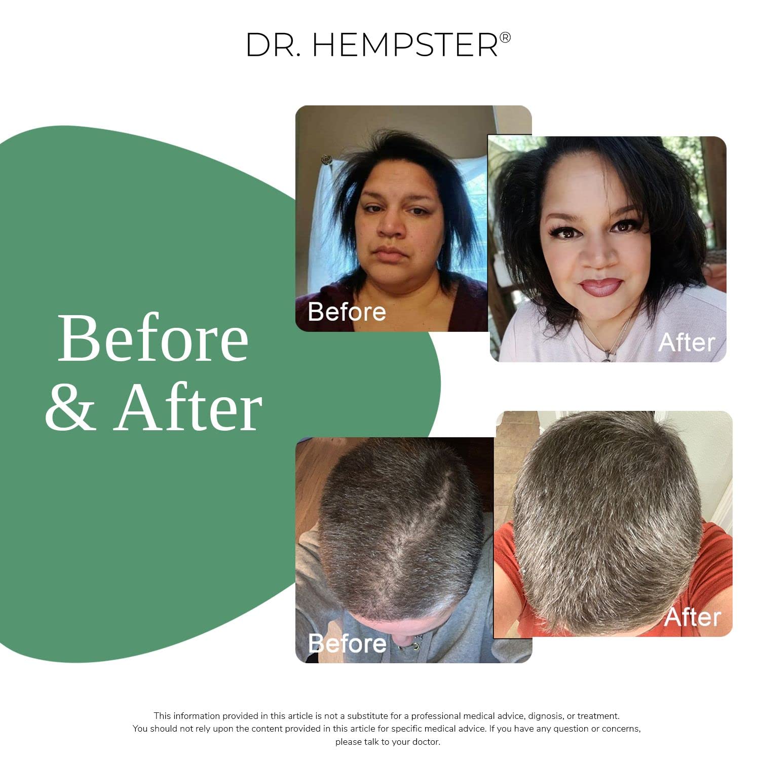 DR. HEMPSTER Biotine & Chanvre – image avant/après suggérant du volume.