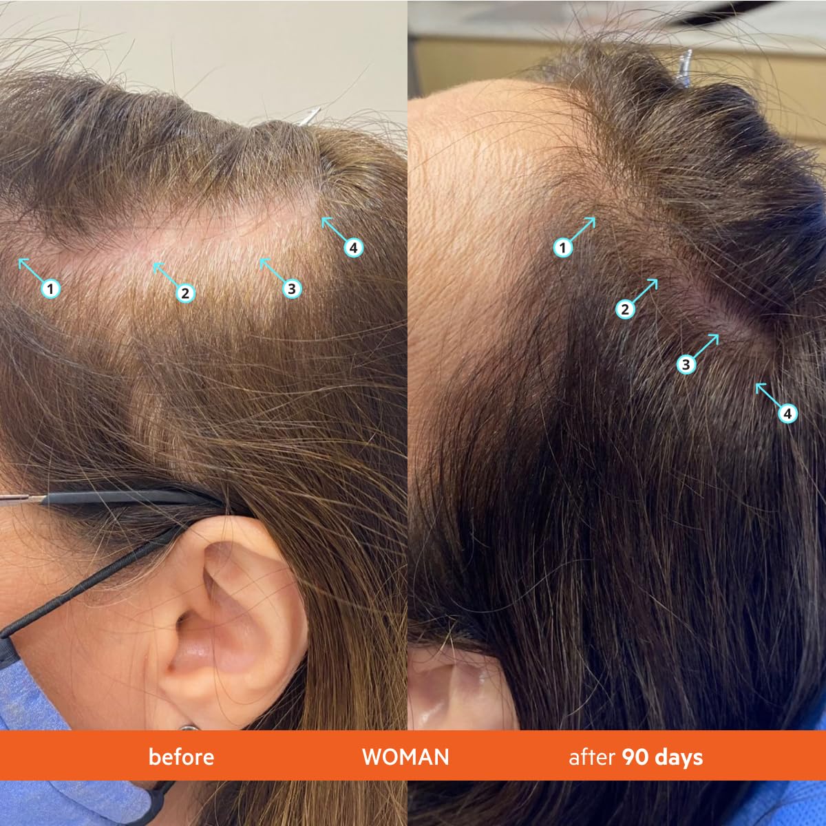 Revita Shampoo DS Laboratories, cuir chevelu sain et cheveux revitalisés après lavage.