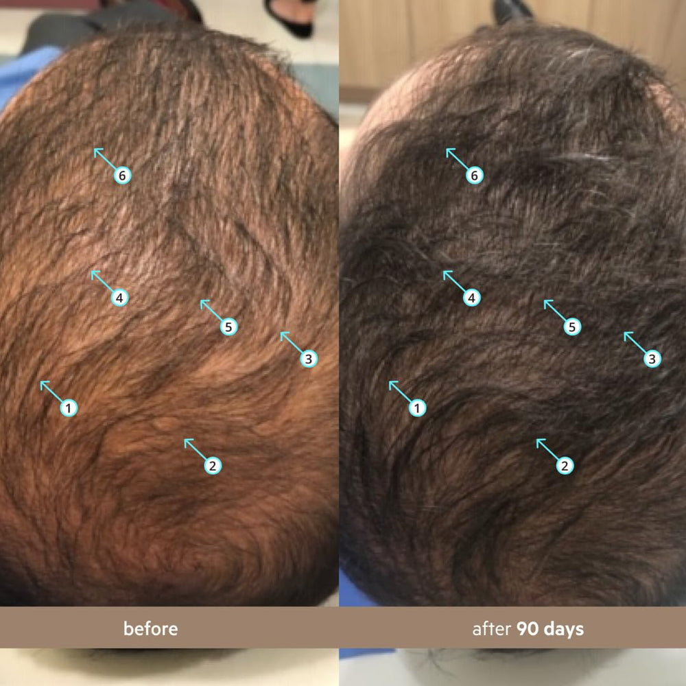 Application ciblée sur cuir chevelu pour routine quotidienne.