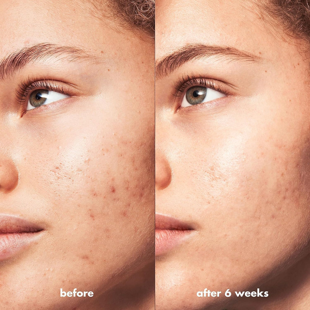 e.l.f. SKIN Blemish Breakthrough Clarifie les pores lors du nettoyage quotidien.