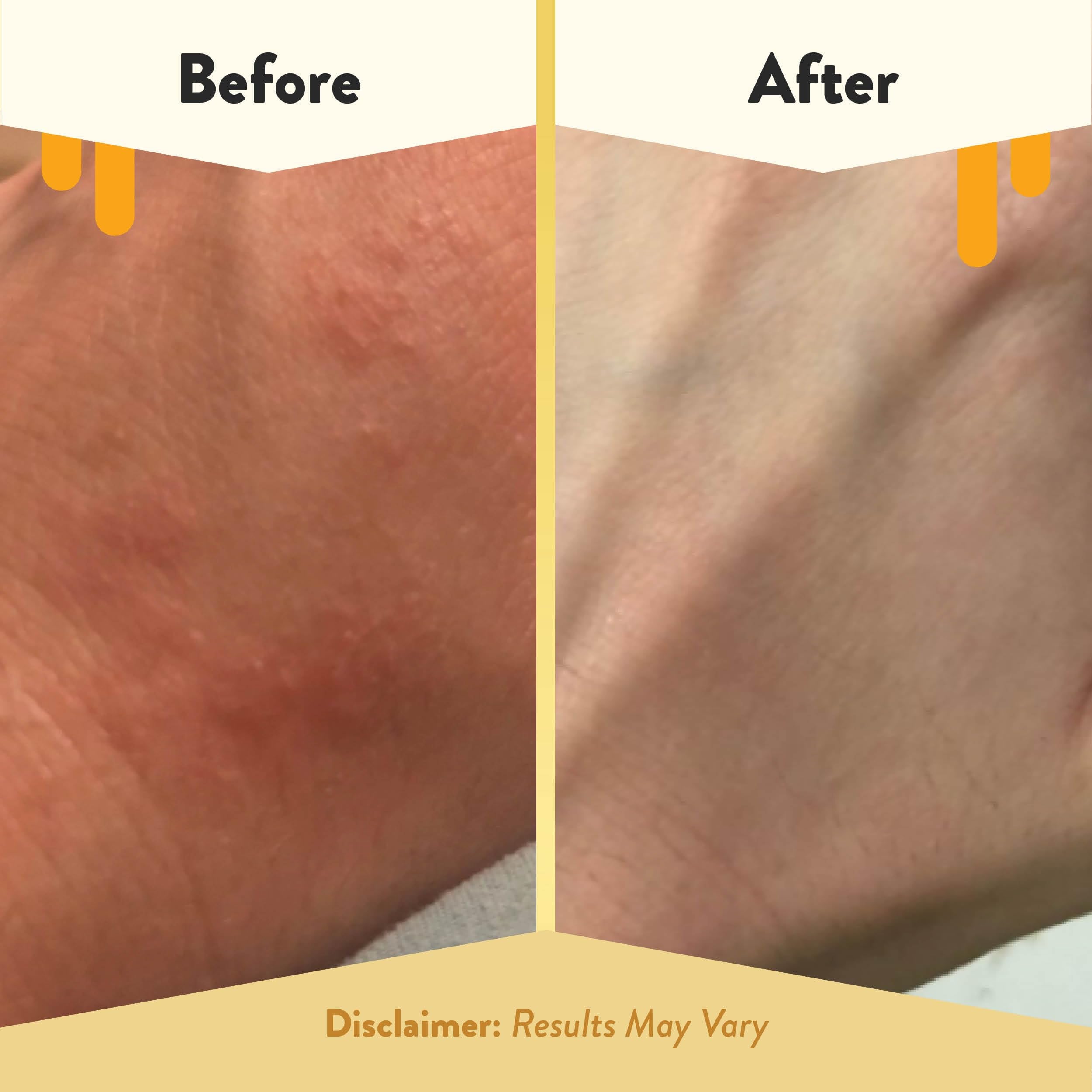 ECZEMA HONEY Apaise les irritations et démangeaisons cutanées.