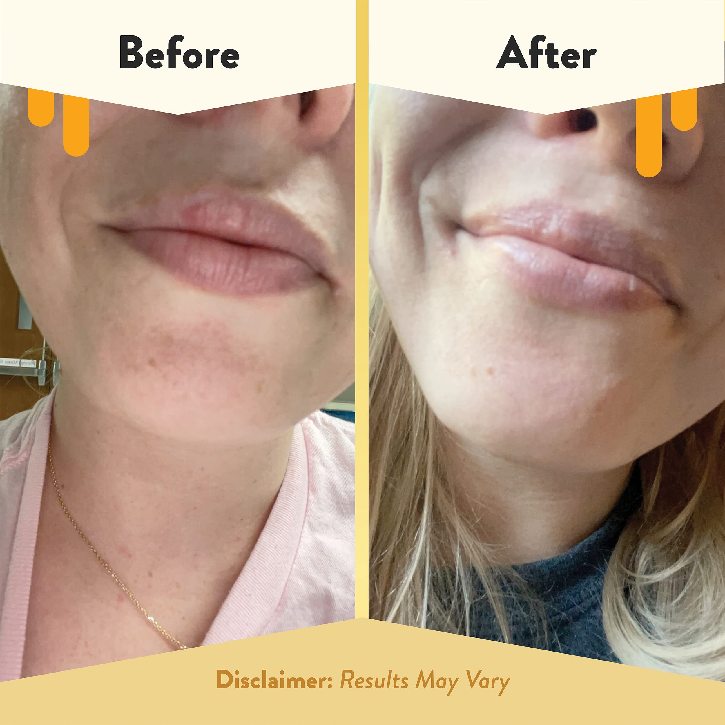 Application sur les lèvres, baume Eczema Honey offre une sensation douce.