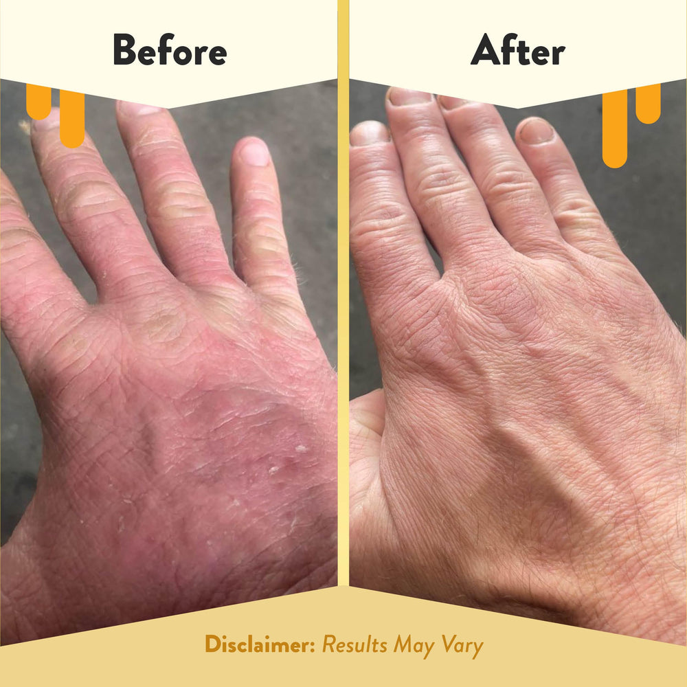 ECZEMA HONEY – Formule sans parfum adaptée aux peaux sensibles.