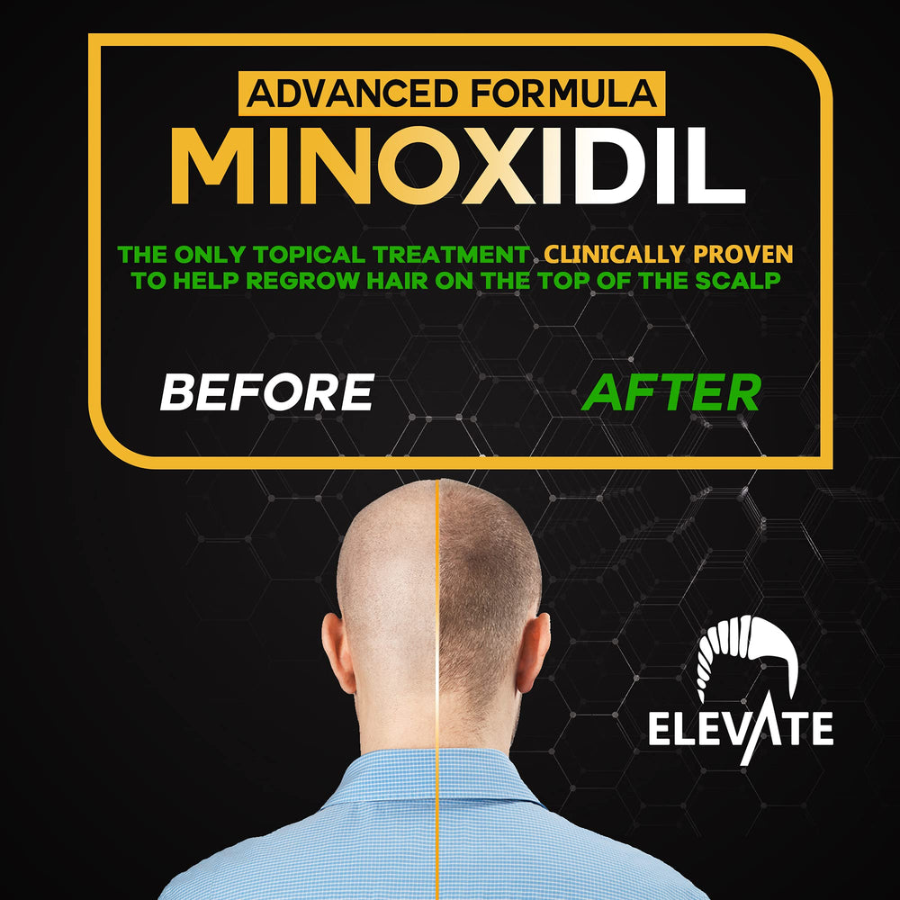 Elevate minoxidil spray applied to scalp showing targeted use