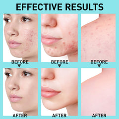 Enaskin Naturals spot treatment on chin demonstrates targeted relief from hormonal breakouts.