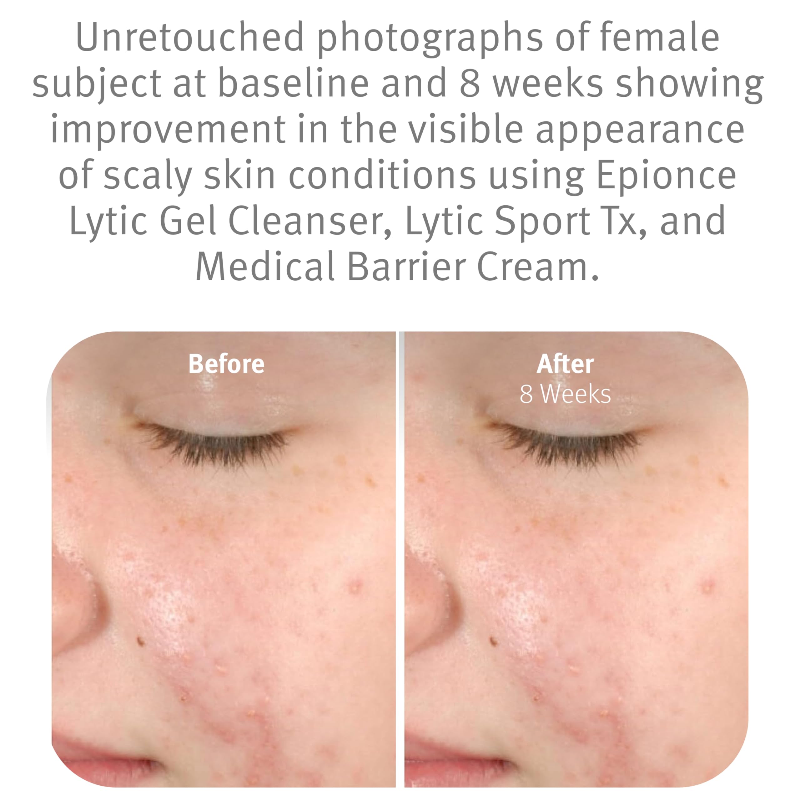 Epionce Lytic Gel Nettoyant – application mains humides, dissout maquillage et impuretés.