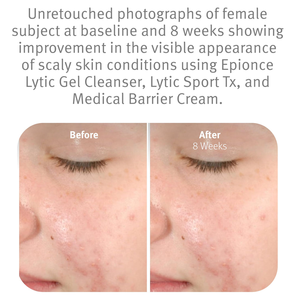 Epionce Lytic Gel Nettoyant – application mains humides, dissout maquillage et impuretés.