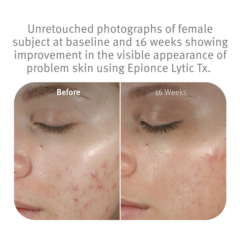Epionce Lytic Tx : texture crème visible, idéale pour lisser les irrégularités