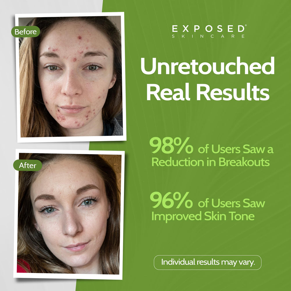 Exposed Skin Care tonique acide salicylique 1% pour pores nets