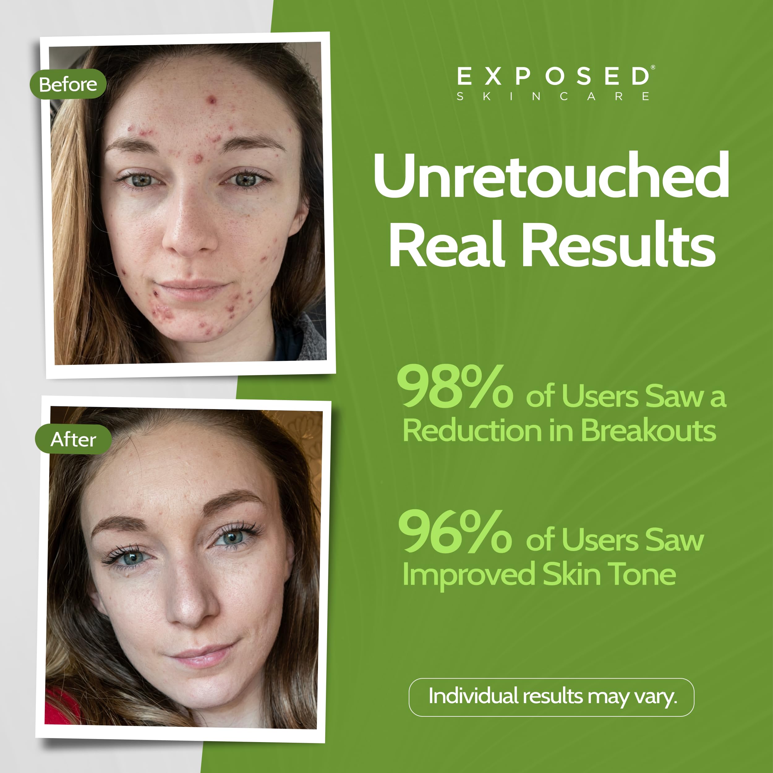 Exposed Skin Care kit flacons pompe, application facile pour réduire les boutons.