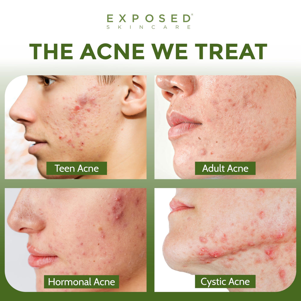 Exposed Skin Care kit produits alignés pour une routine simple et efficace.