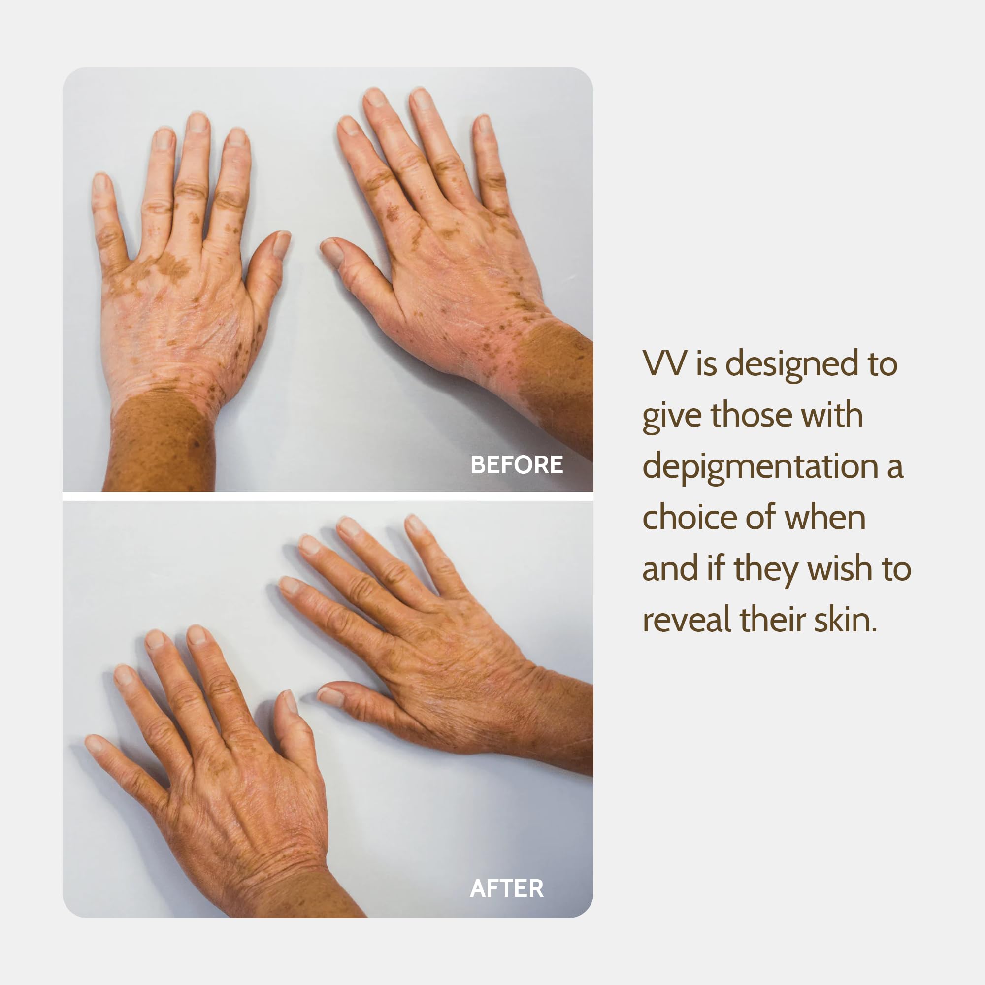 Application visage Fake Bake Vitiligo Vanquish pour un teint homogène.