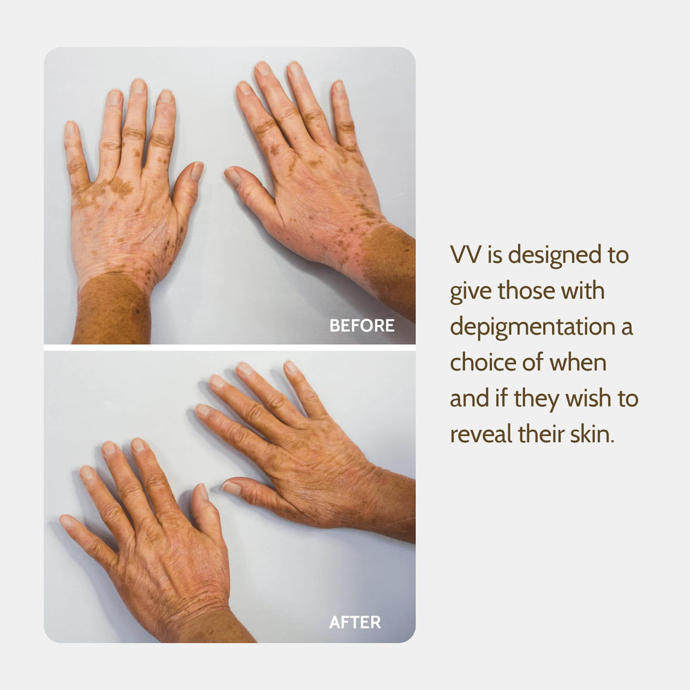 Application visage Fake Bake Vitiligo Vanquish pour un teint homogène.