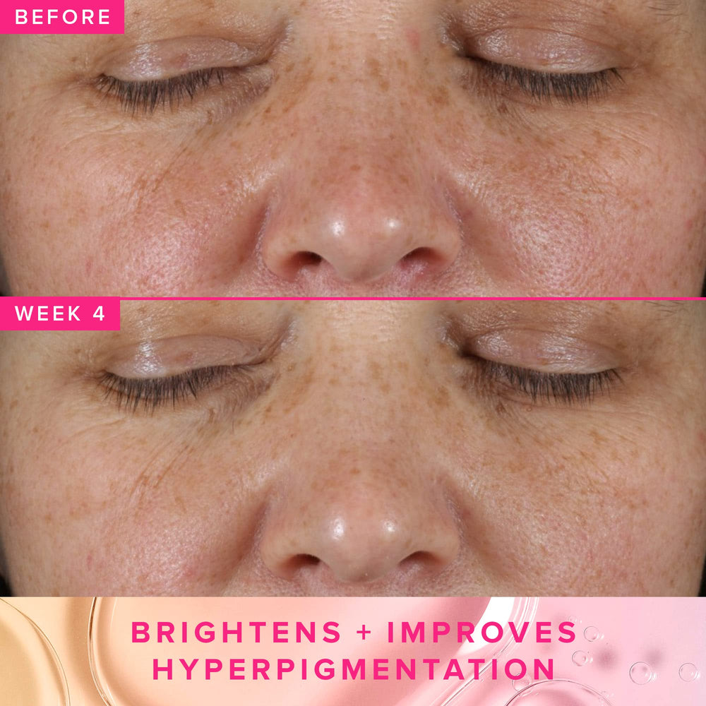 Exfoliation légère avec pha 5% révélant une peau plus homogène.