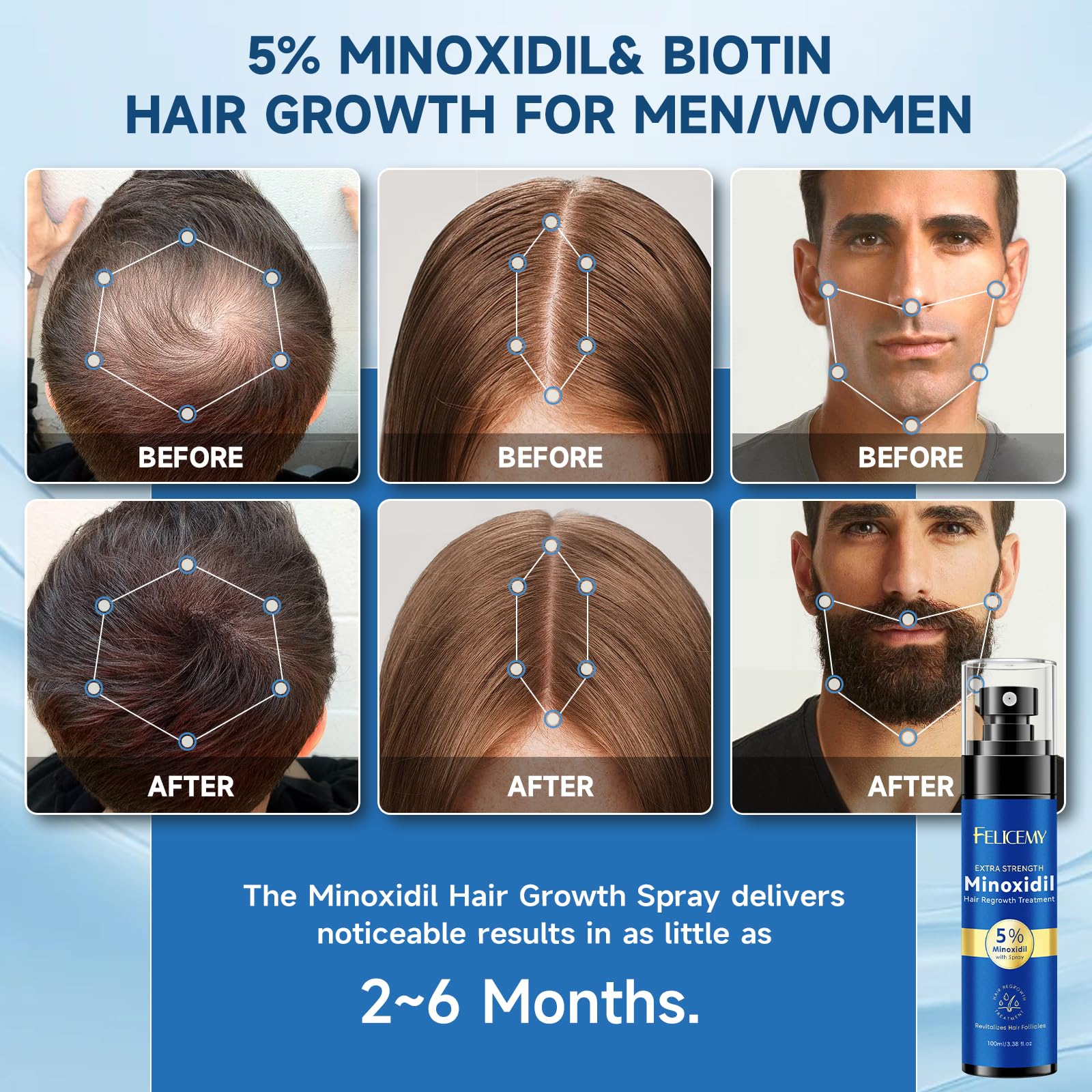 Felicemy Minoxidil bouteille pompe 5% pour cheveux.