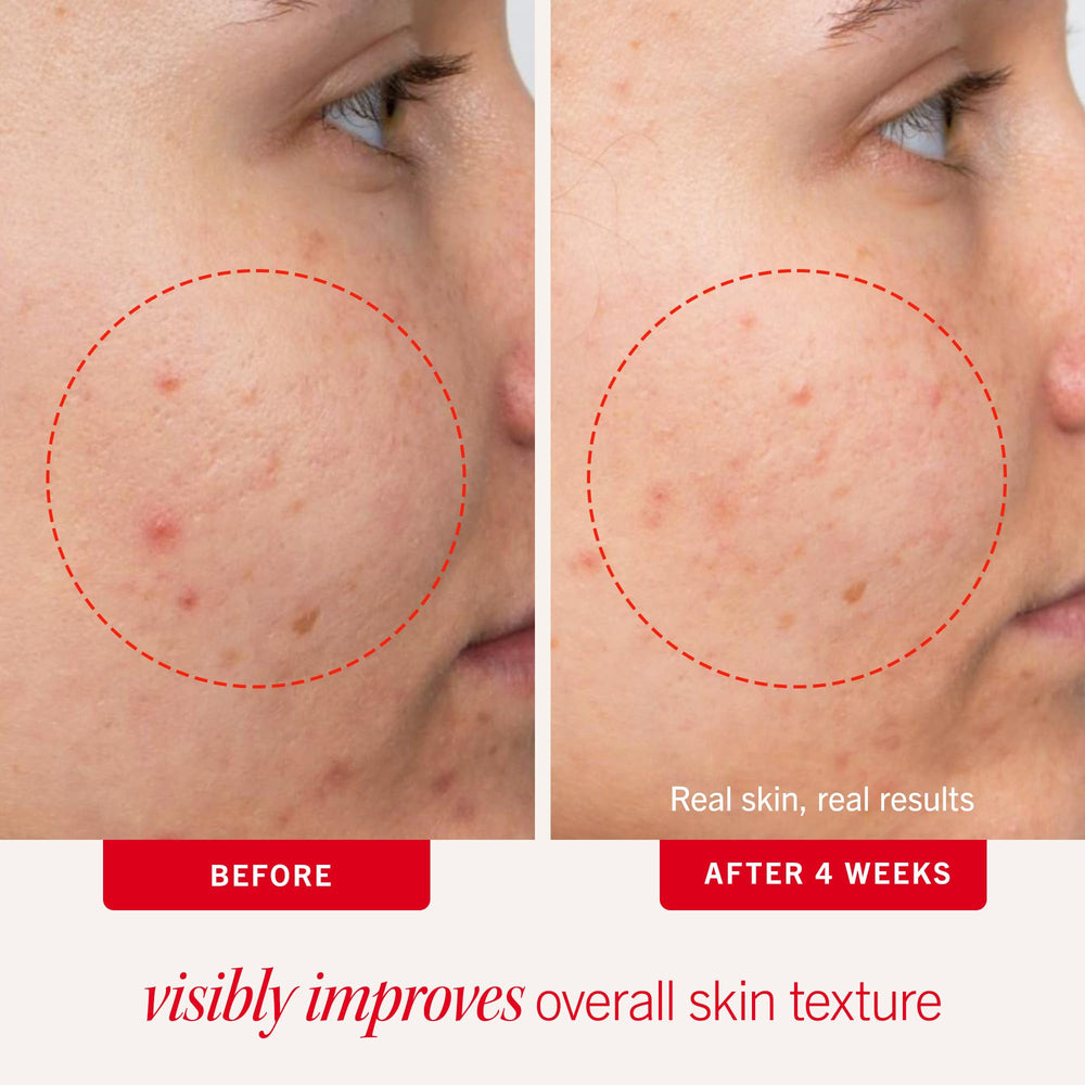 First Aid Beauty Acne Pads visage, acide salicylique 2% pour pores plus propres.