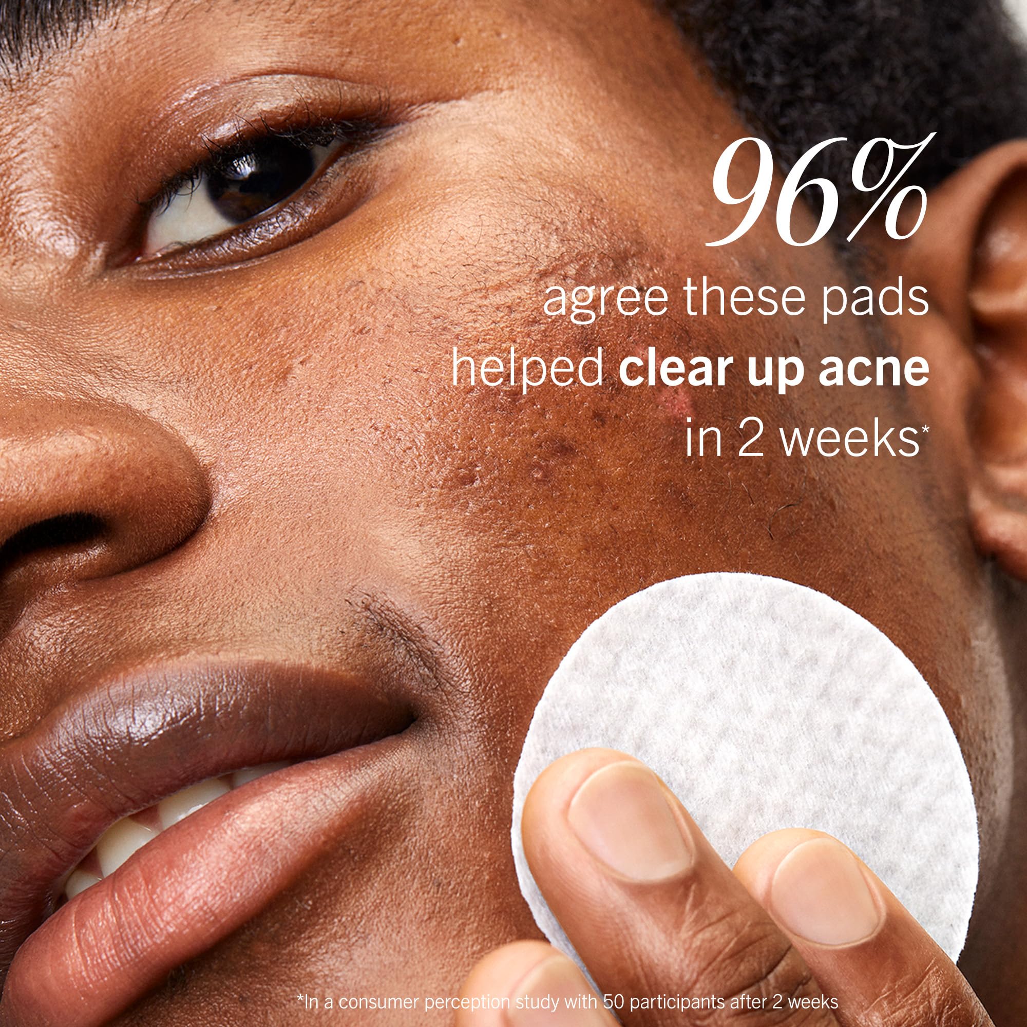First Aid Beauty Acne Pads visage, texture douce respectant la barrière cutanée.