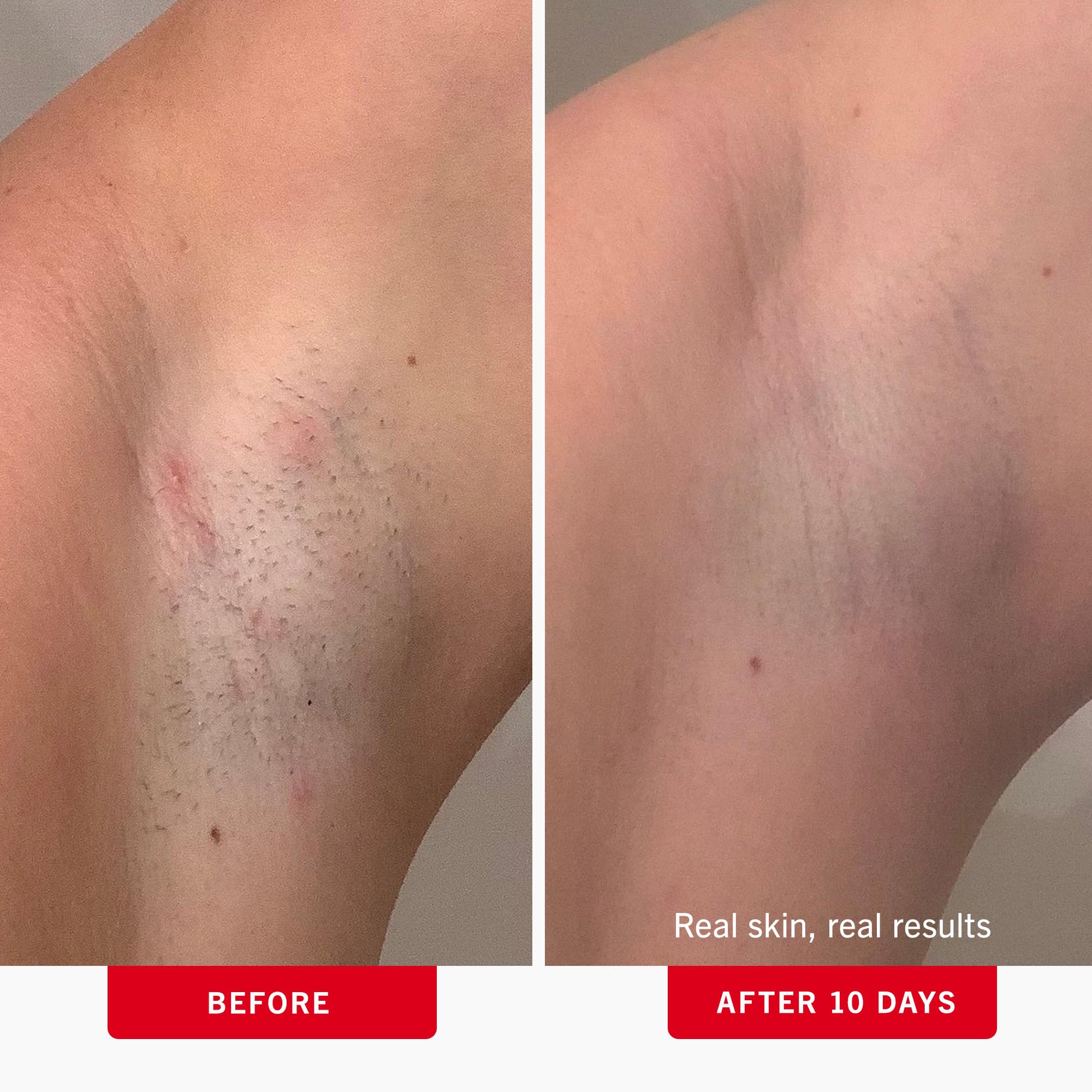 Tampon First Aid Beauty ligne bikini, réduction des irritations post-rasage.
