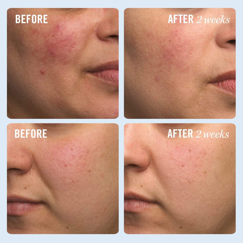 Application visage avec First Aid Beauty Ultra Repair Cream pour un confort rapide.