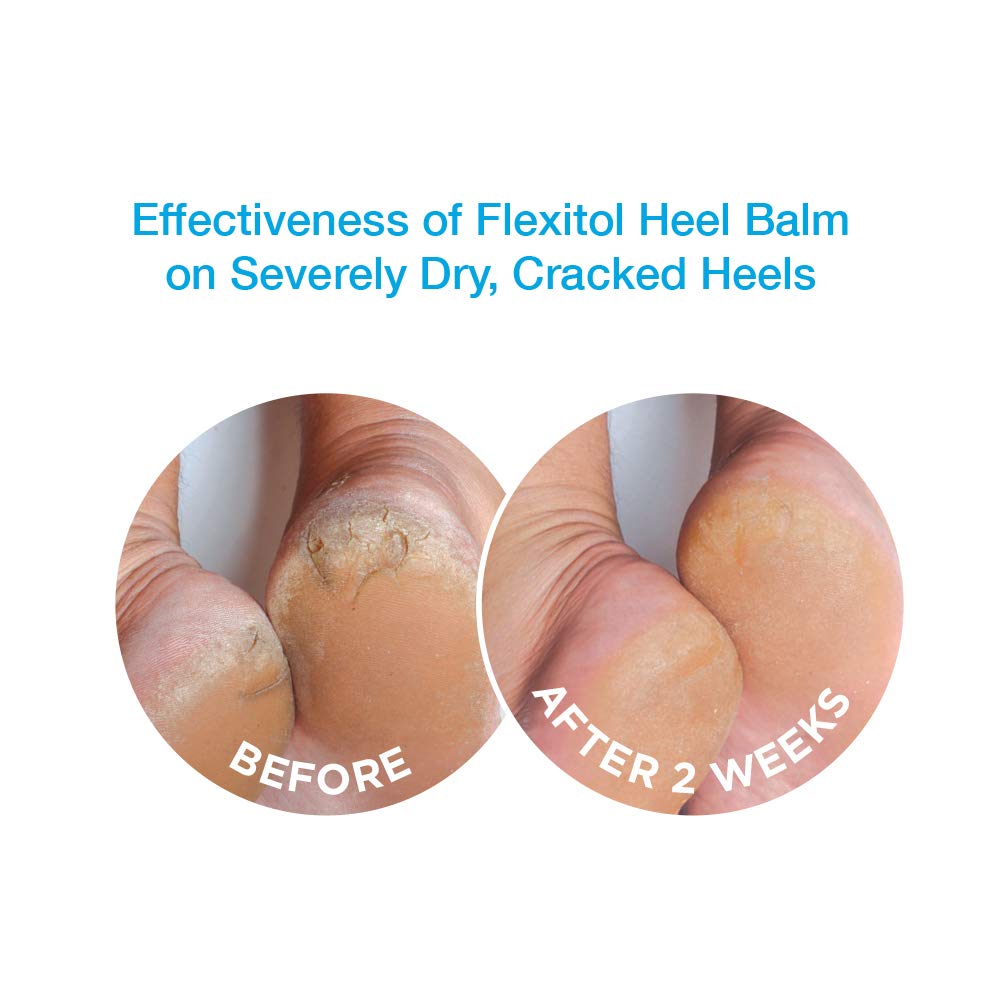 Avant-après avec Flexitol Baume Talons sur pieds secs.