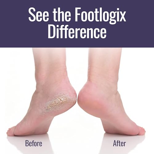 Footlogix Application Callus Softener – méthode simple pour traiter pieds rugueux.