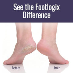 Footlogix Application Callus Softener – méthode simple pour traiter pieds rugueux.