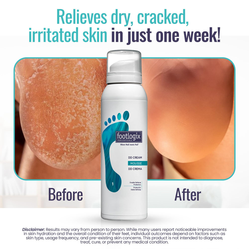 FOOTLOGIX DD Cream Mousse hydrate intensément les pieds secs.