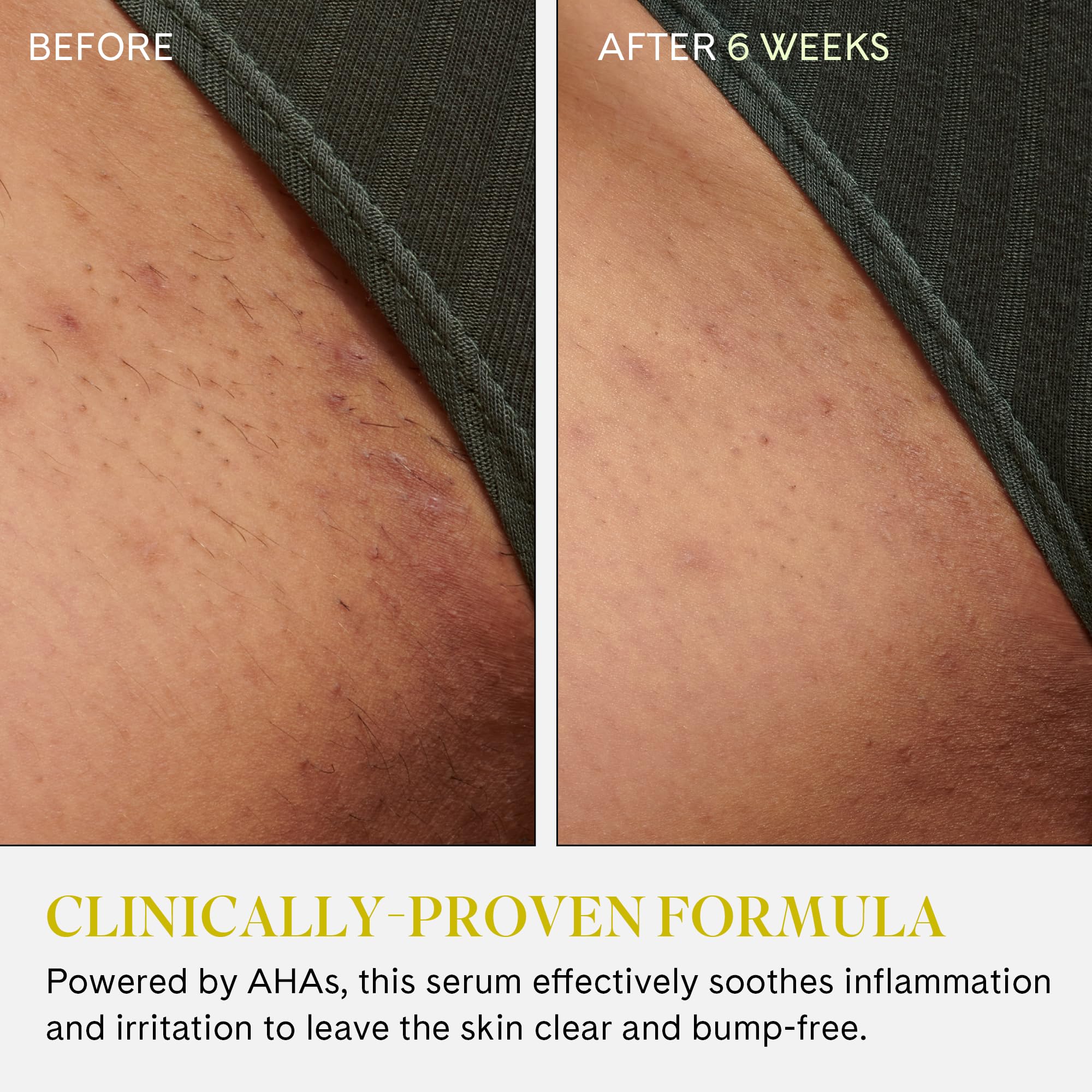 Acides AHA et BHA ciblent les irrégularités pour une peau plus uniforme