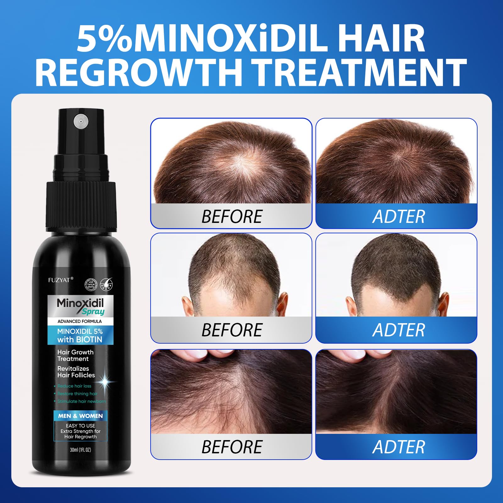 FUZYAT Minoxidil – appliquer-matin-soir, routine simple pour cheveux forts.