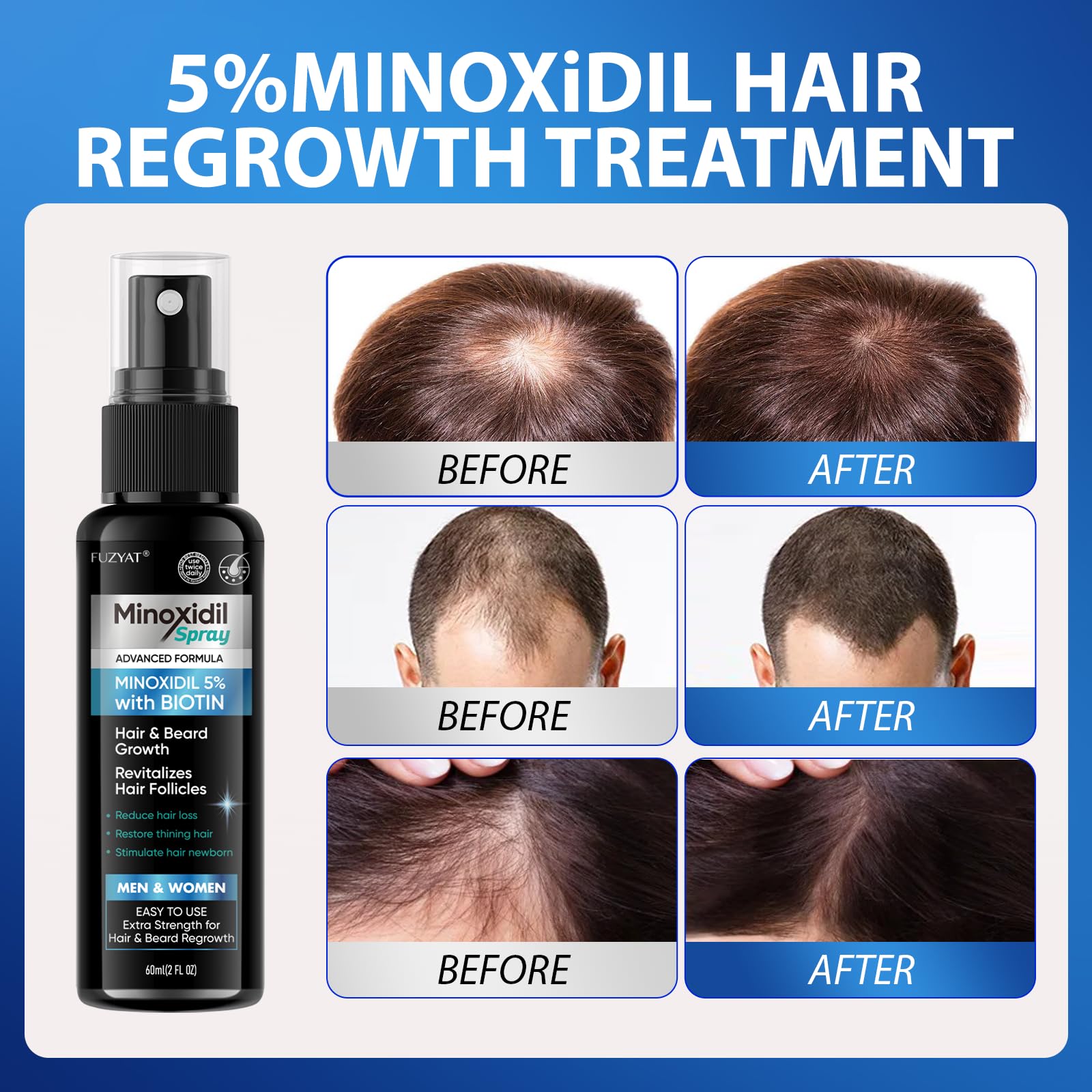 FUZYAT Minoxidil spray — format léger et pratique au quotidien.