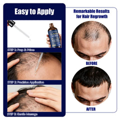 Goutte sur le cuir chevelu, Minoxidil Gemächlich Zu Hause, ciblage précis