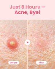 GLAM UP patches hydrocolloïdes 10mm et 12mm – s’adapte à diverses imperfections.