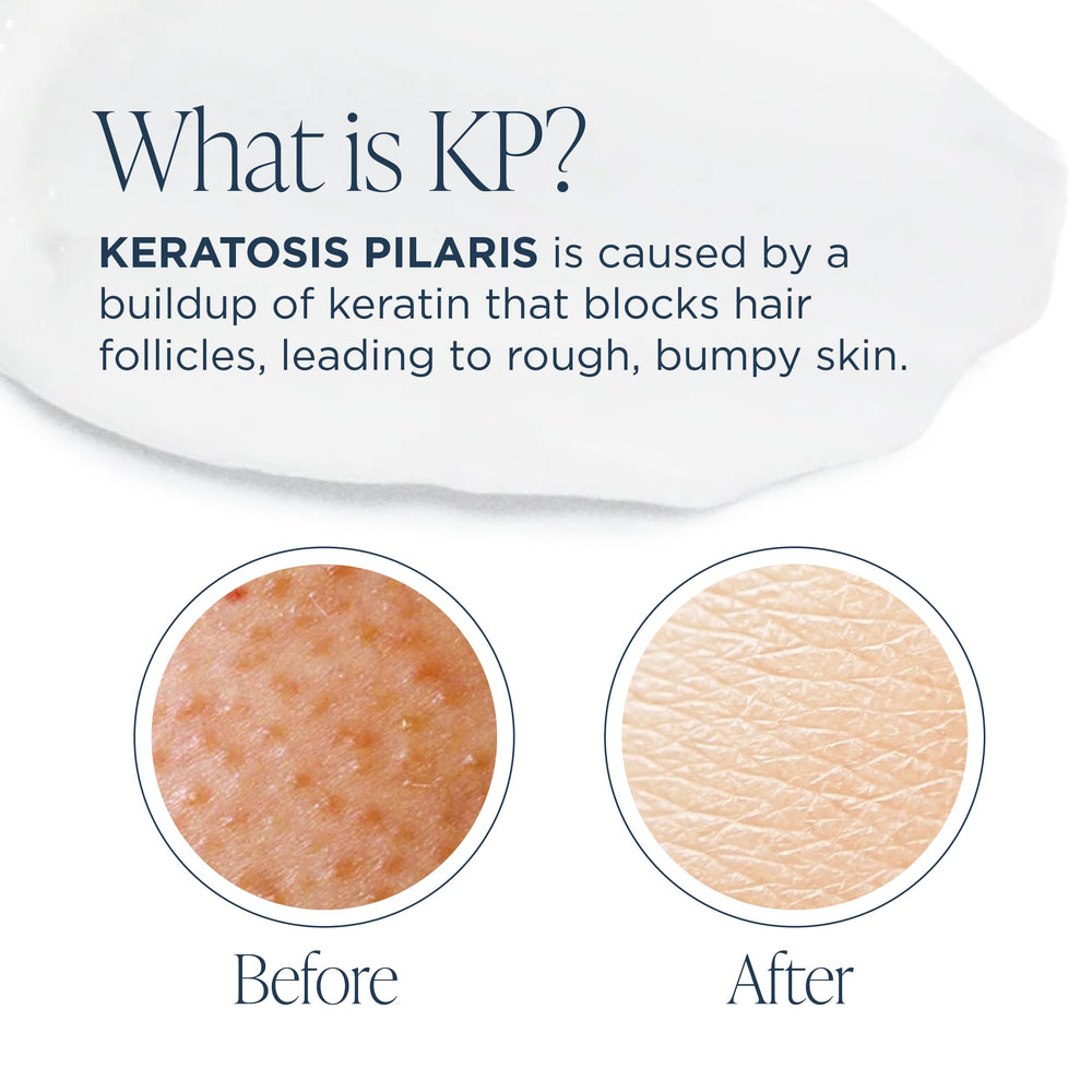Glytone KP Kit : pouf de douche pour une exfoliation efficace.