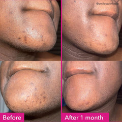 Good Molecules barre acide tranéxamique et acide kojique sur le visage.