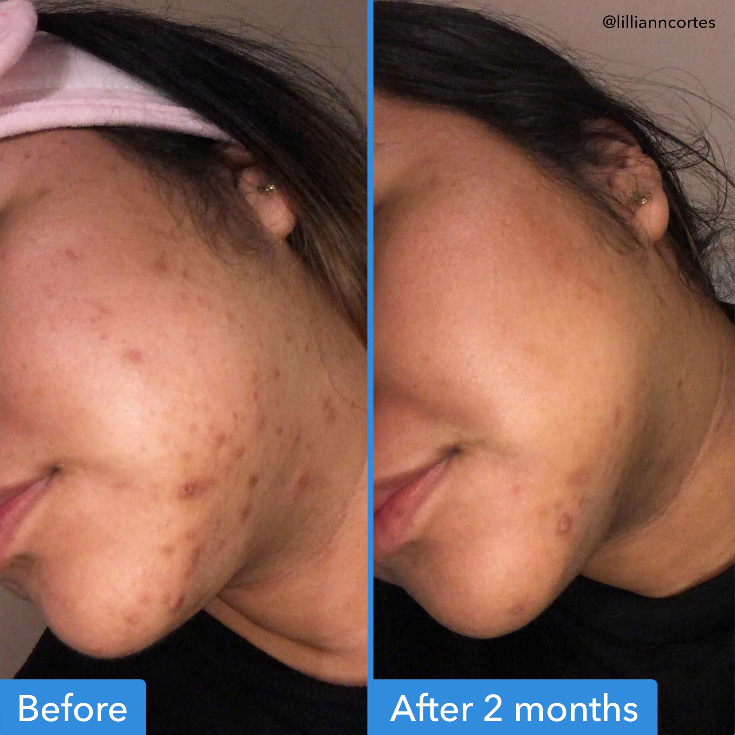 Texture légère du sérum Good Molecules pénétrant rapidement et laissant la peau douce.