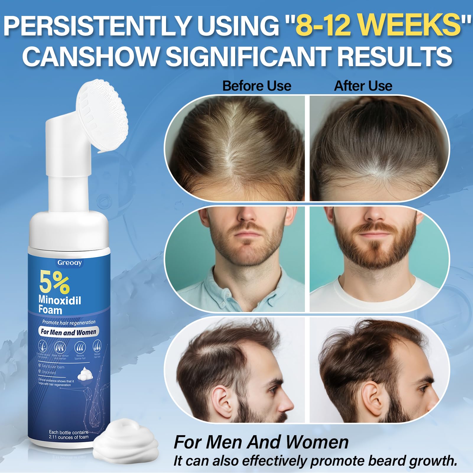 Greoay Applicateur Minoxidil Mousse: application précise et facile sur les zones fines.
