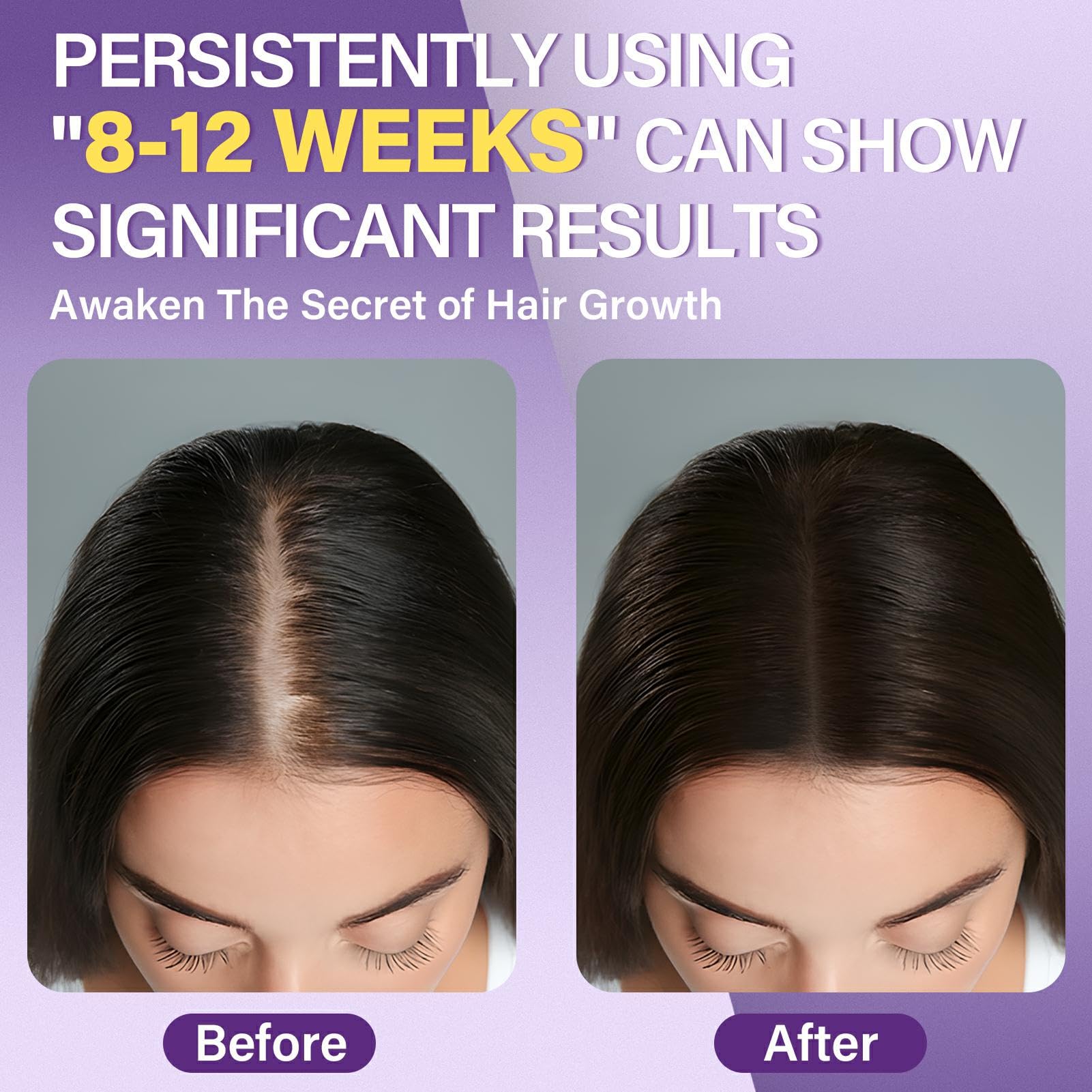Greoay Mousse Minoxidil 5% pour femmes — Application locale précise sur le cuir chevelu