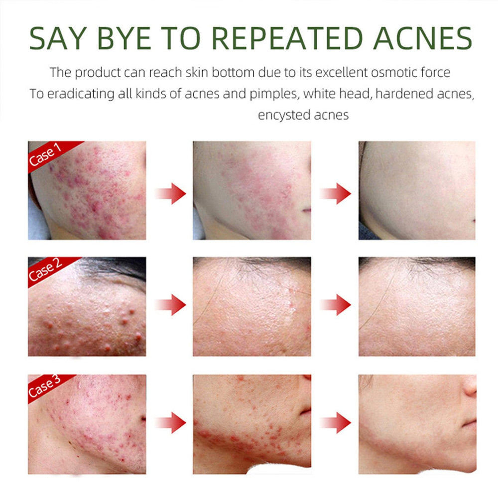 Grospe Crème Anti‑Acné effet apaisant pour le confort cutané.