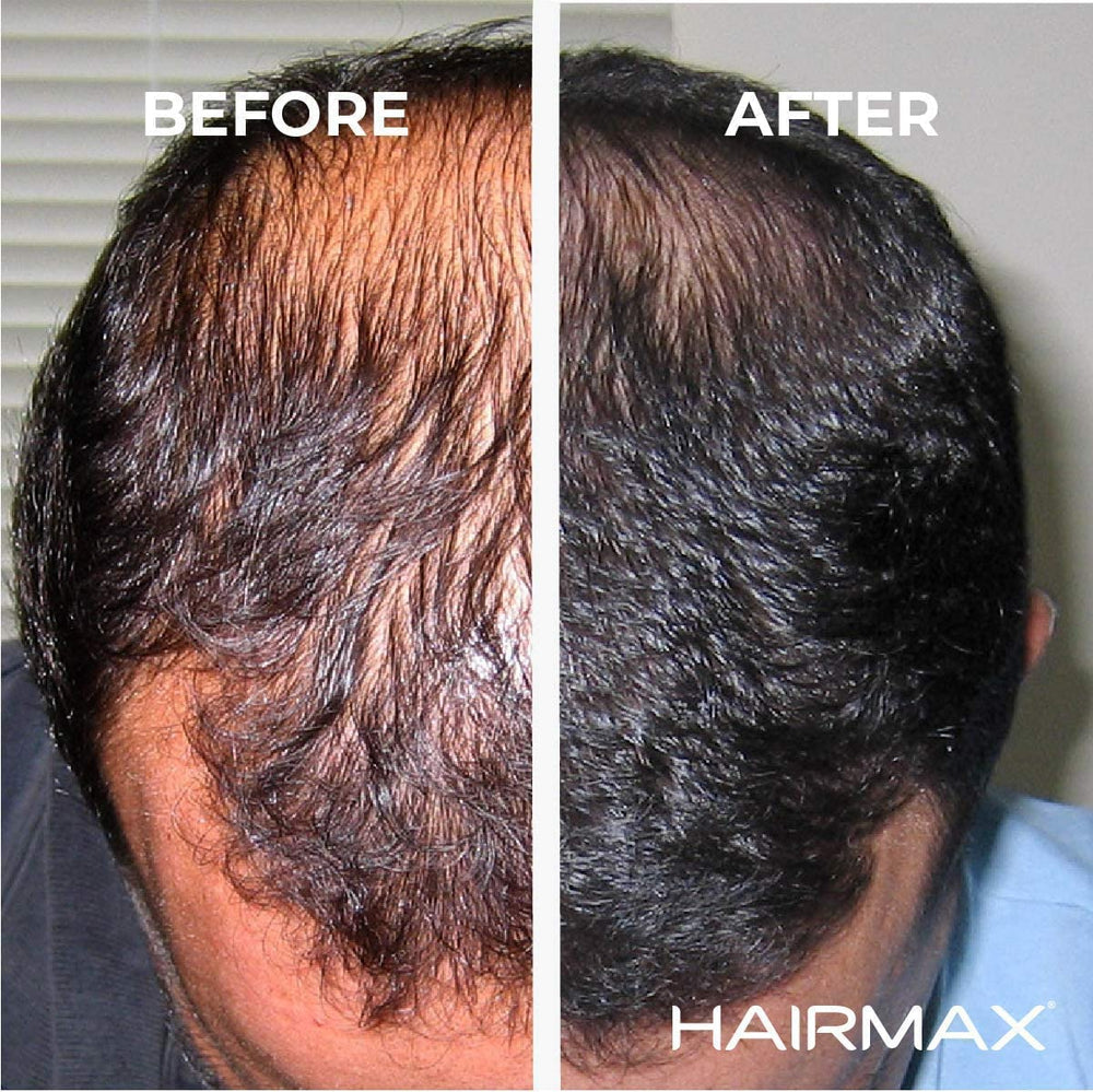 HairMax Ultima 12 LaserComb, aperçu densité cheveux pour une apparence plus fournie.