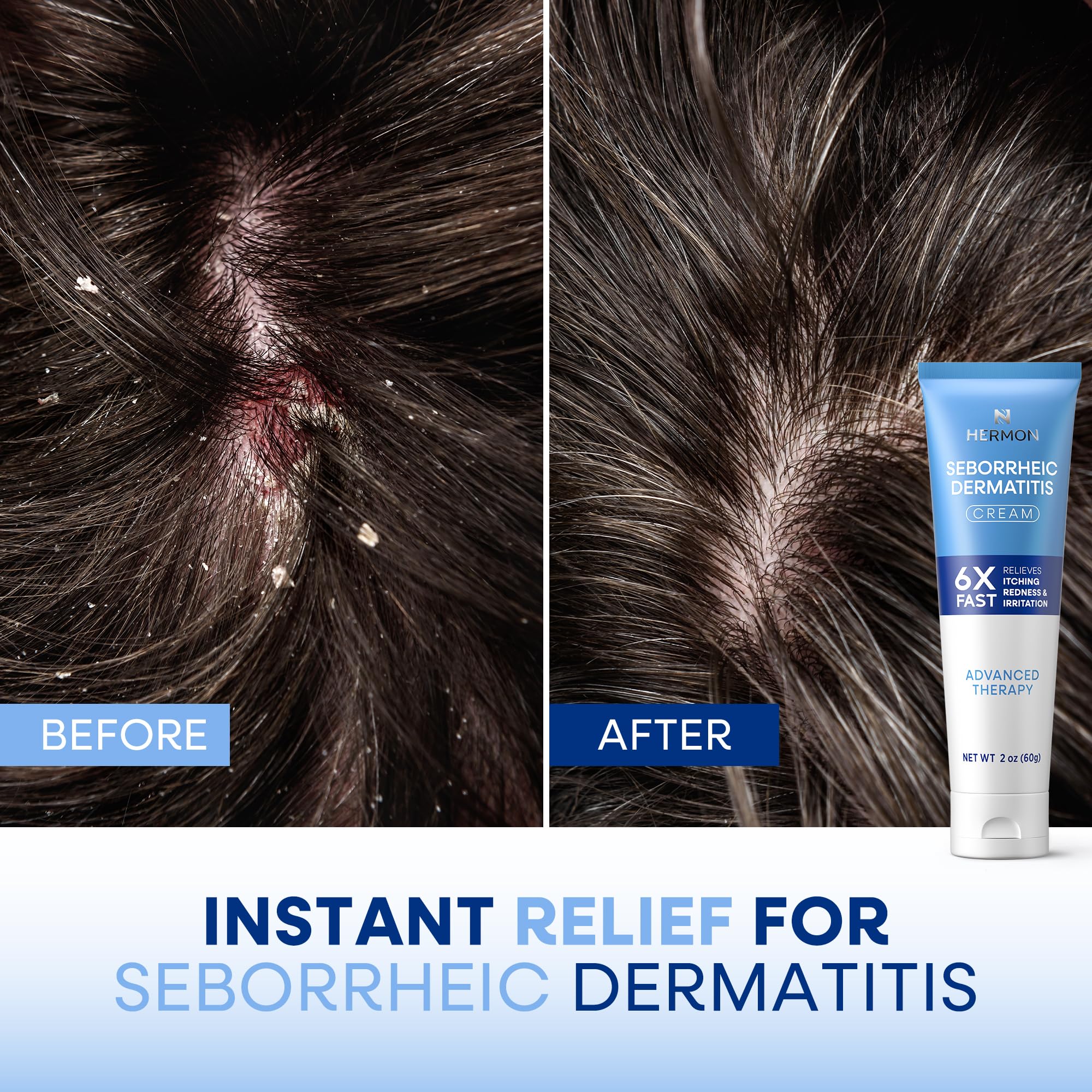 Hermon Crème séborrhéique pour le corps, usage quotidien sur zones sensibles.