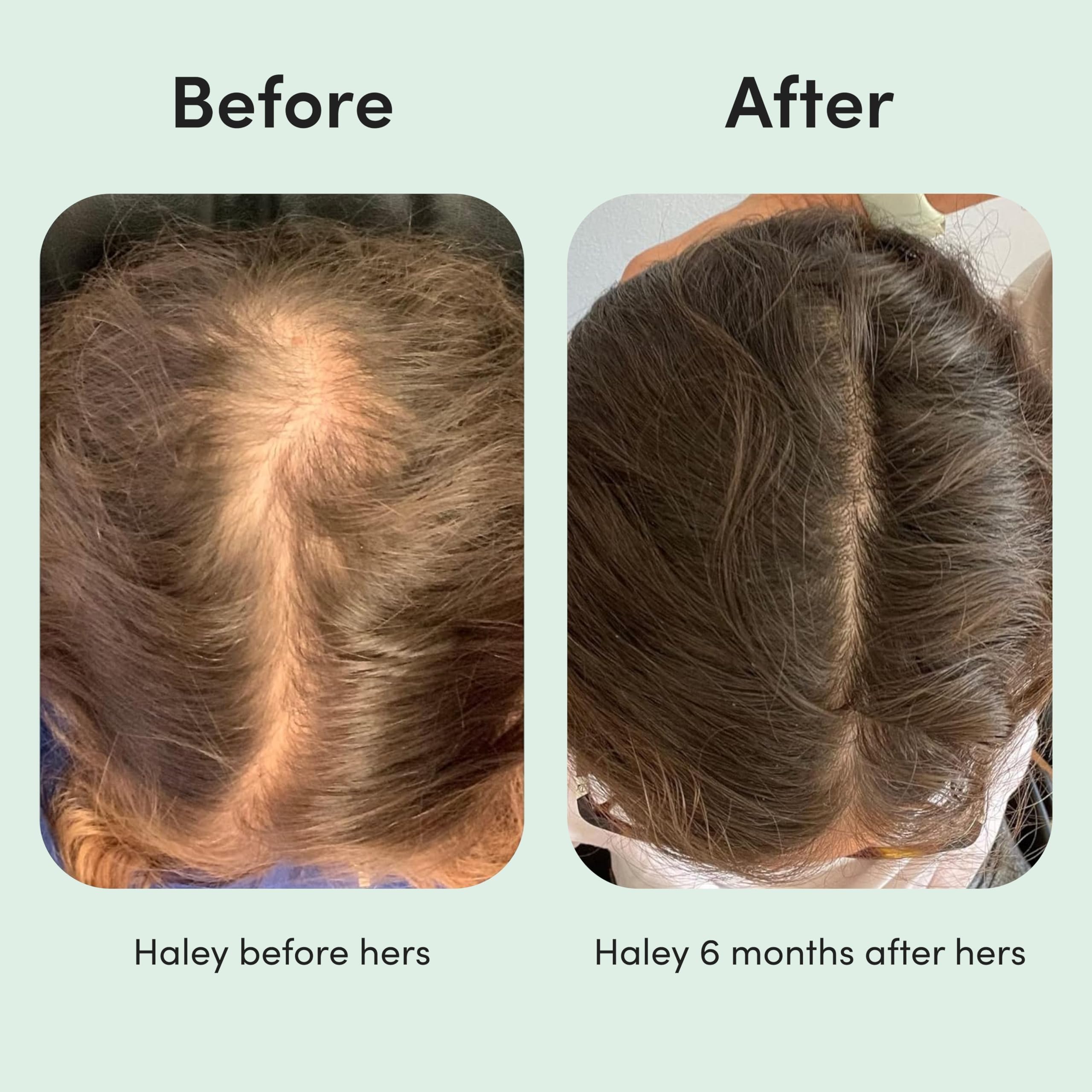 hers minoxidil 2% routine simple, demi-dose appliquée sur le cuir chevelu.