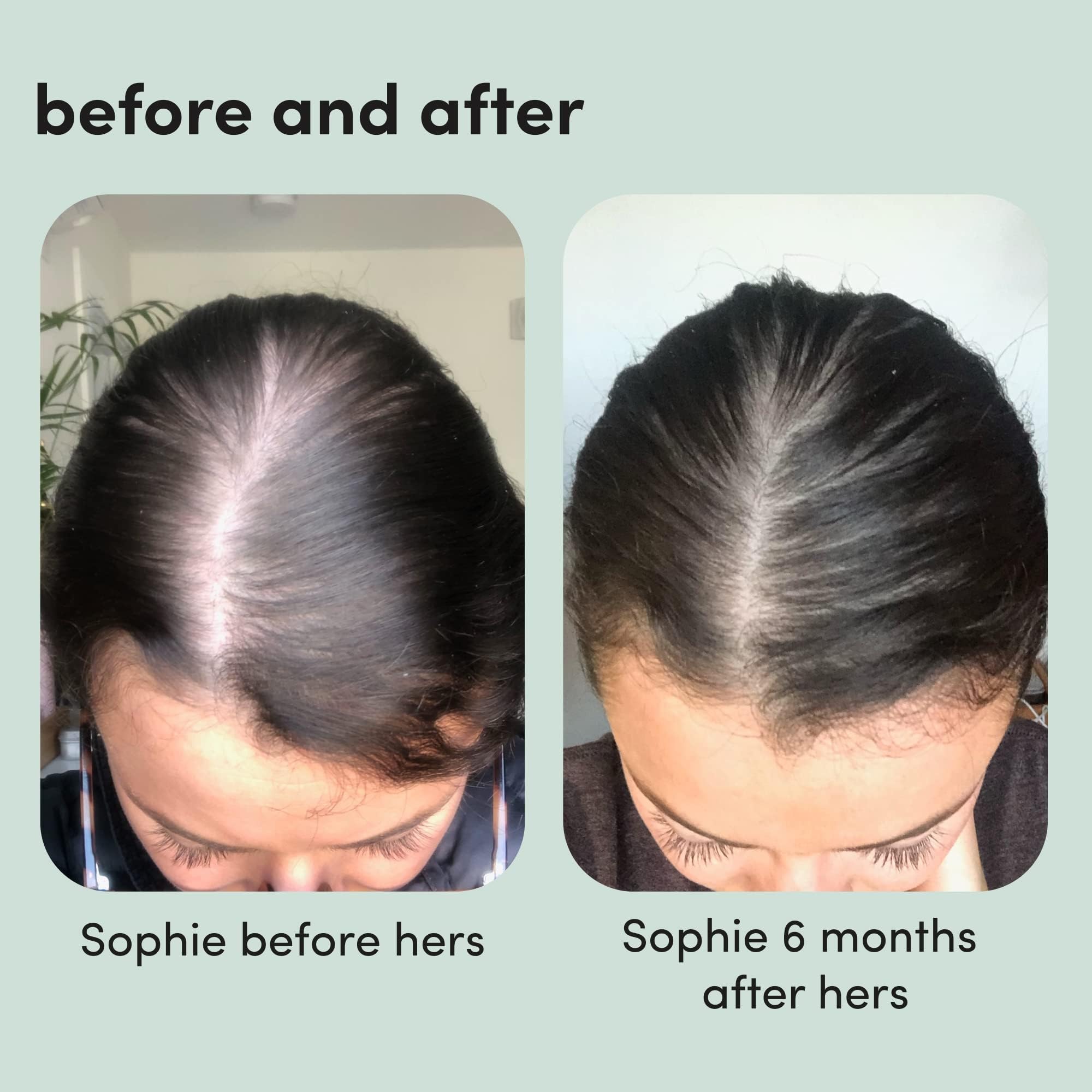 hers minoxidil 5% mousse – effet non gras après application