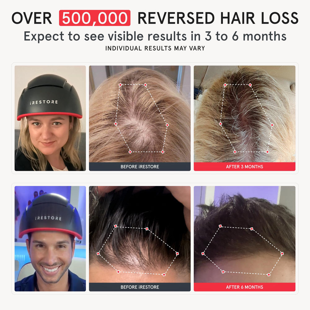 iRestore Elite en profil montrant la couverture du cuir chevelu.