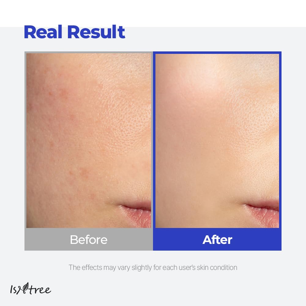 IsNtree Équilibre du sébum et hydratation – peau mixte et grasse.