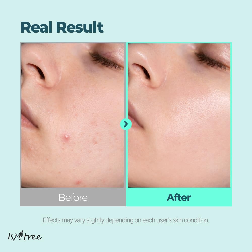 IsNtree Gim PDRN huit types d’acide hyaluronique et peptides