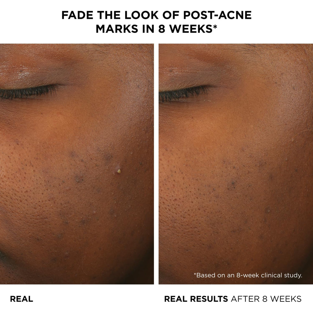 IT Cosmetics Bye Bye Breakout Serum réduction visible des boutons après application.