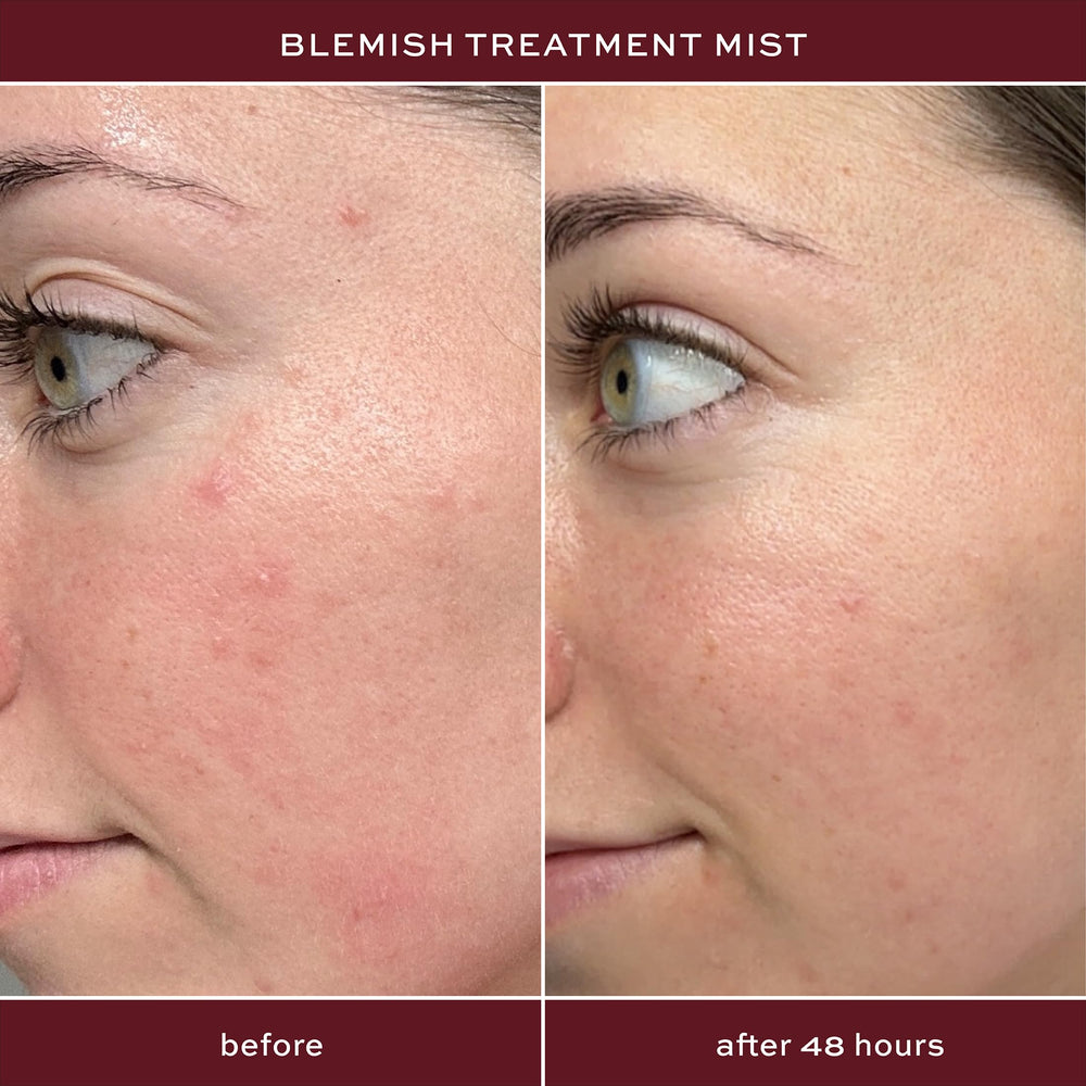 ITK Skincare Spray dos et epaule, action ciblée sur les imperfections